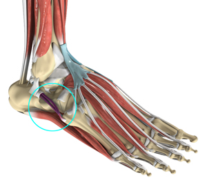 Peroneal Tendonitis Educational Picture