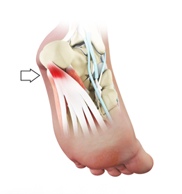 Plantar Fasciitis Educational Picture