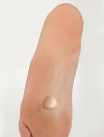 Plantar Fibroma Educational Picture