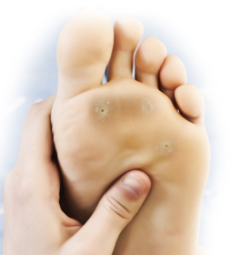 Plantar Warts Educational Picture
