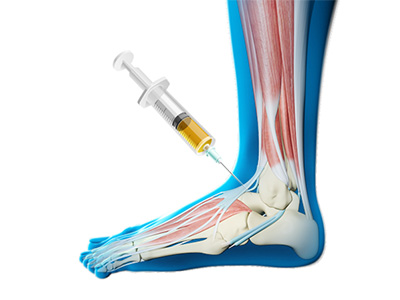 Platelet-Rich Plasma (PRP) for the Ankle - Educational Picture
