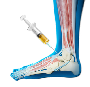 Platelet-Rich Plasma (PRP) for the Ankle Educational Picture