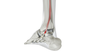 Posterior Tibial Tendon Dysfunction Educational Picture