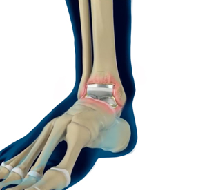 Revision Total Ankle Replacement