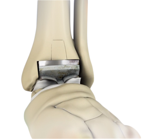 Revision Foot &  Ankle Surgery Educational Picture