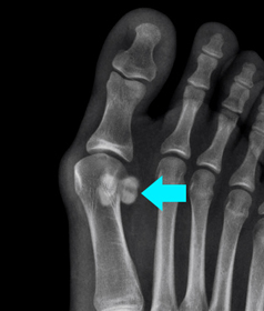 Sesamoid Fracture Educational Picture