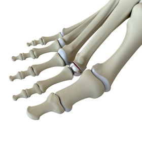 Small Toe Replacement Surgery