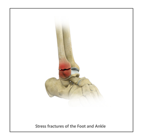 Stress Fractures of Foot &  Ankle Educational Picture