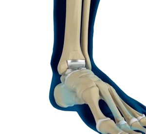 Stryker Total Ankle Replacements