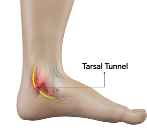 Tarsal Tunnel Syndrome Educational Picture