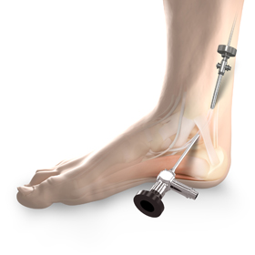 Tendoscopy Educational Picture