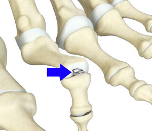 Toe Deformity Correction Educational Picture