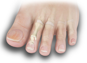Toe Fractures Educational Picture