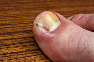Toenail Conditions Educational Picture