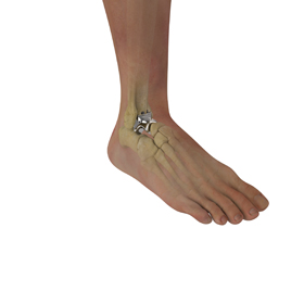 Total Talus Replacement Educational Picture