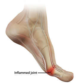 Turf Toe Educational Picture