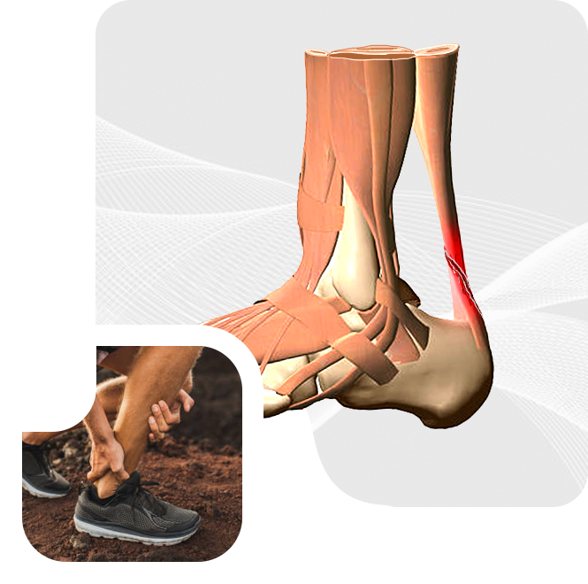 Achilles Tendon Rupture Procedure