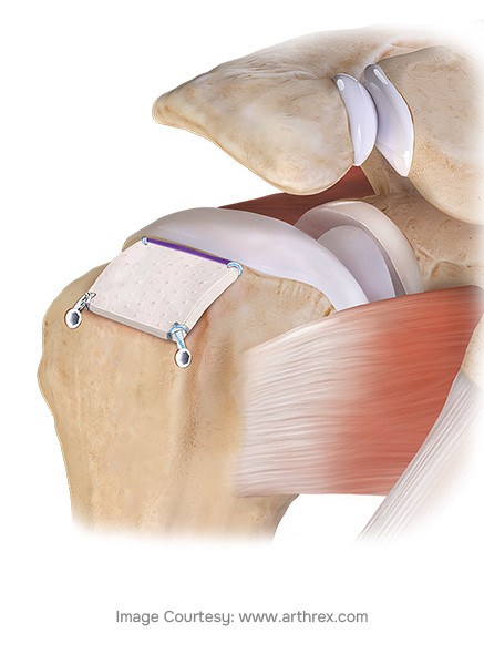 Minimally Invasive Surgery