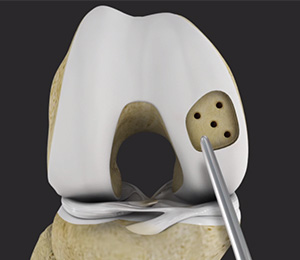 Cartilage Preservation Techniques Images