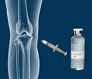 Combined Hyaluronic Therapy for the Knee Images