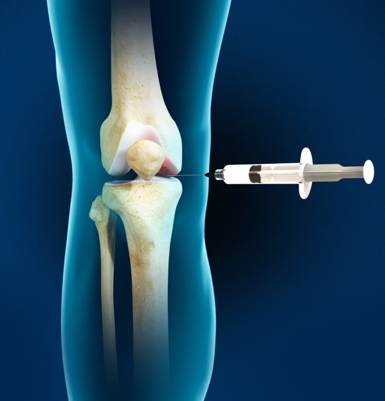 Durolane Injection for Osteoarthritis Images