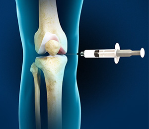 Durolane Injections of the Knee Images