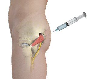 Hip Injections Images