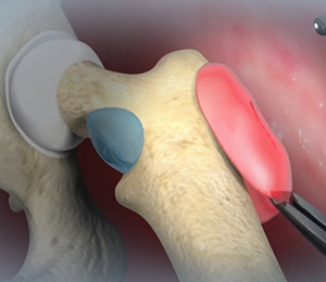 Hip Tenotomy Images