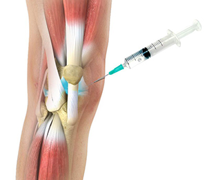 Hyaluronic Acid Injections Images