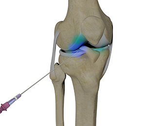 Intra-Articular Joint Injections Images