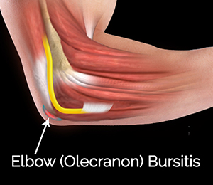 Non-Surgical Elbow Treatments Images