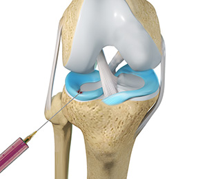 Orthobiologic Treatments for Meniscus Tear Images