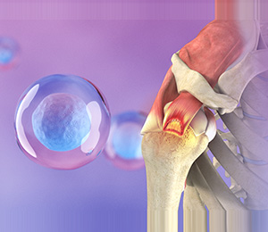 Orthobiologic Treatments for Rotator Cuff Tears Images