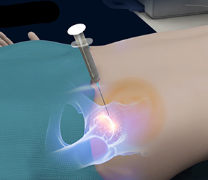 Orthobiologics for the Hip Images