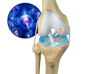 Orthobiologics for the Knee Images