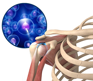 Orthobiologics Treatment for Shoulder Images