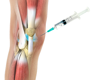 Orthovisc and Monovisc Hyaluronic Acid Injections  Images