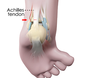 Percutaneous Needle Tenotomy Images