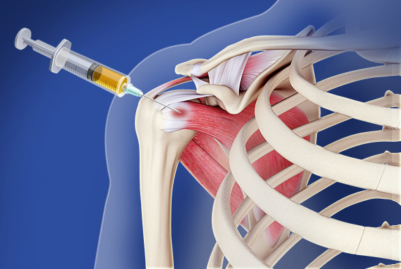 Platelet-Rich Plasma (PRP) for the Shoulder Images