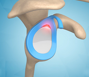 Shoulder Sports Injuries Images