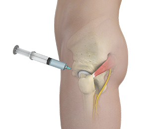 Soft Tissue Injections Images