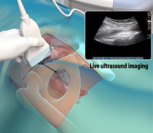 Ultrasound-Guided Hip Injections Images