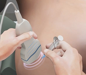 Ultrasound-Guided Joint Aspiration Images