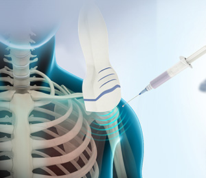Ultrasound-Guided Shoulder Injections Images
