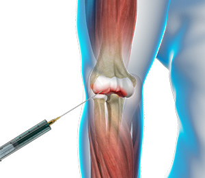 Viscosupplementation for Elbow Arthritis Images