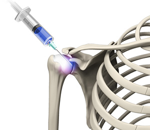 Viscosupplementation for Shoulder Arthritis Images