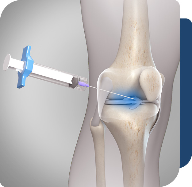 Hyaluronic Acid Injections