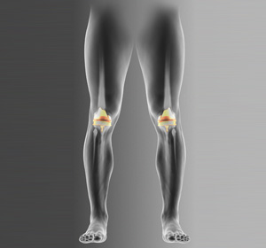 Bilateral Knee Replacement