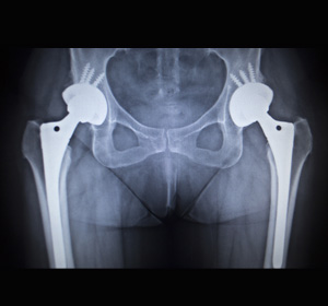 Bilateral Total Hip Replacement
