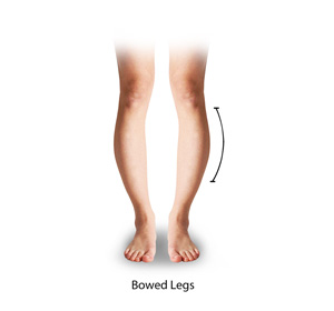 Bowed Legs